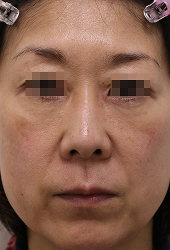 顔全体の症例写真（After）／50代 女性