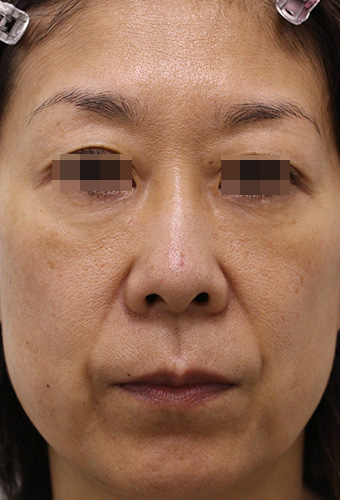 顔全体の症例写真（Before）／50代 女性