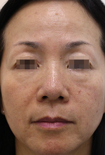 顔全体の症例写真（After）／50代 女性