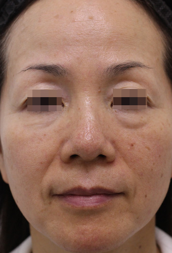 顔全体の症例写真（Before）／50代 女性