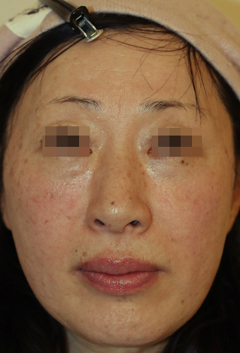 顔全体の症例写真（After）／50代 女性