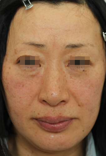 顔全体の症例写真（Before）／50代 女性