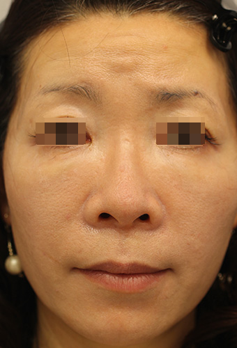 顔全体の症例写真（After）／40代 女性