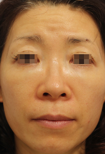 顔全体の症例写真（Before）／40代 女性