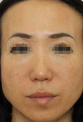 顔全体の症例写真（After）／50代 女性