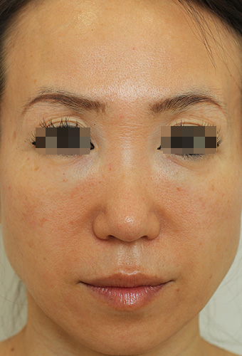顔全体の症例写真（Before）／50代 女性