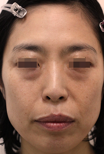 顔全体の症例写真（After）／40代 女性