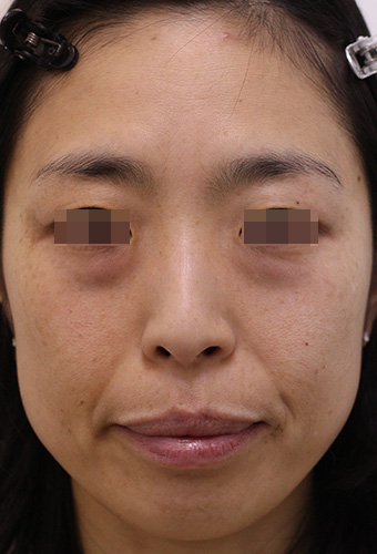 顔全体の症例写真（Before）／40代 女性
