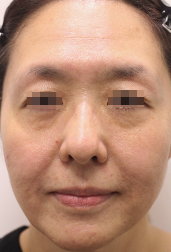 顔全体の症例写真（After）／40代 女性