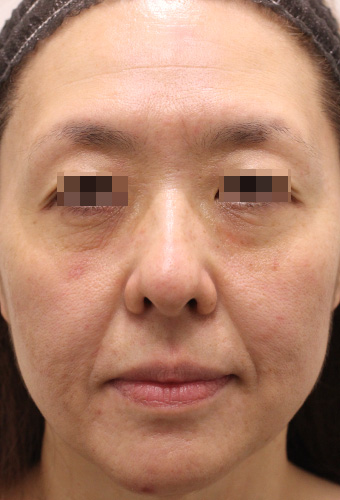 顔全体の症例写真（Before）／40代 女性