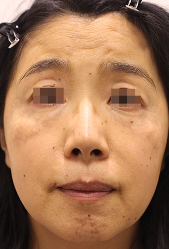顔全体の症例写真（Before）／50代 女性