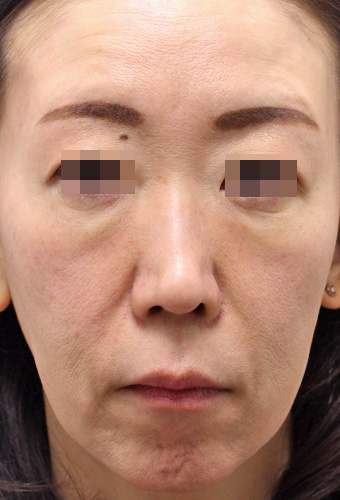 顔全体の症例写真（After）／50代 女性