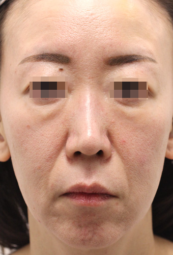 顔全体の症例写真（Before）／50代 女性