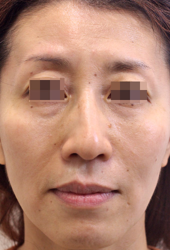 顔全体の症例写真（After）／40代 女性