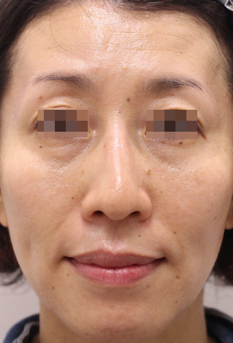 顔全体の症例写真（Before）／40代 女性