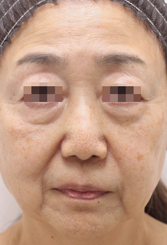 顔全体の症例写真（After）／60代 女性