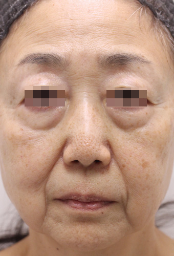 顔全体の症例写真（Before）／60代 女性