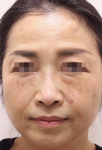顔全体の症例写真（After）／50代 女性
