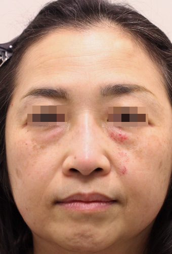 顔全体の症例写真（Before）／50代 女性