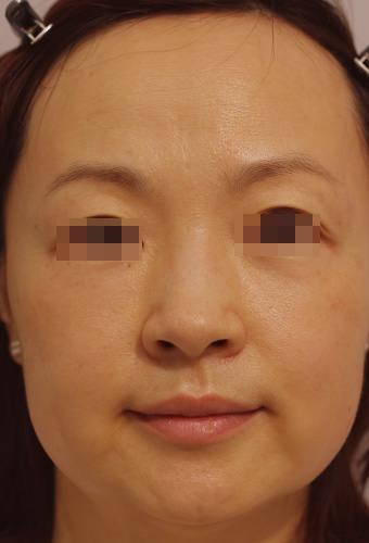 顔全体の症例写真（After）／40代 女性