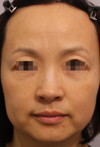 顔全体の症例写真（Before）／40代 女性