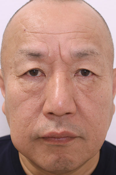 顔全体の症例写真（After）／55代 男性