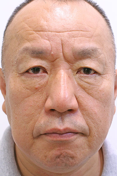 顔全体の症例写真（Before）／55代 男性