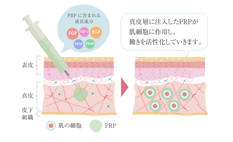 血小板を使うと肌はどうなるの