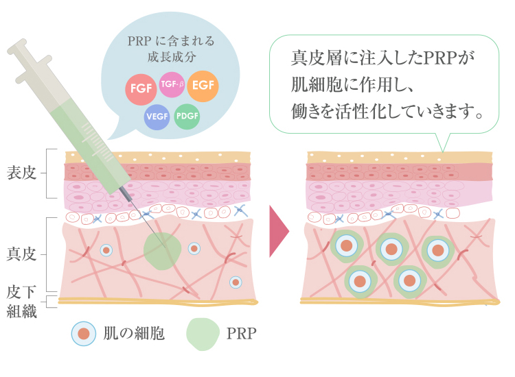 血小板を使うと肌はどうなるの